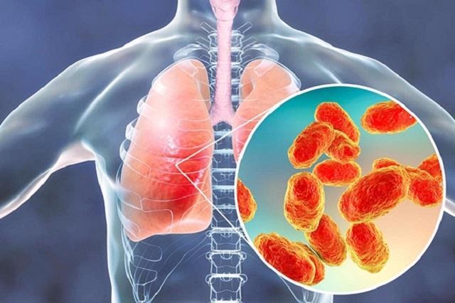 Viêm phổi là gì, chữa được không? Triệu chứng, nguyên nhân và điều trị - Chi tiết tin tức