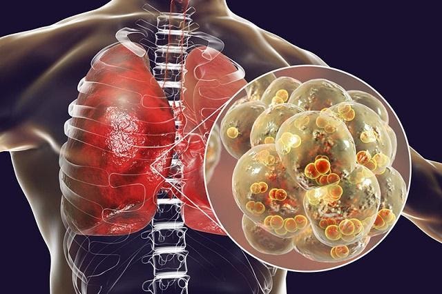 Viêm phổi là gì, chữa được không? Triệu chứng, nguyên nhân và điều trị - Chi tiết tin tức